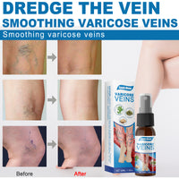 30ml Varicose Veins Treatment Spray Varicose Vein Treatment Cream Repair Varicocele Removal Pain Relief Kidney Inflammation Legs Vein Health Care Spray